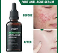 Anti Acne Face Serum for Clear & Glowing Skin – Oil Control Tea Tree Serum 30ml
